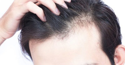 195 Hair Loss PLR articles